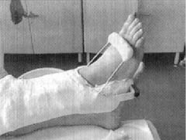 (PDF) Achilles tendon rupture Assessment of nonoperative