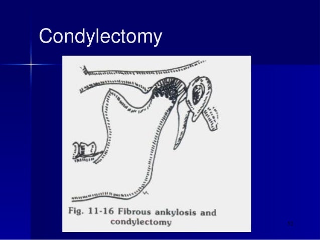 Treatment of temporomandibular joint ankylosis by