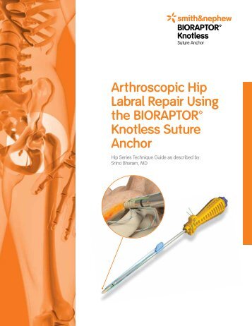 Reverse Total Shoulder Protocol PatientPop