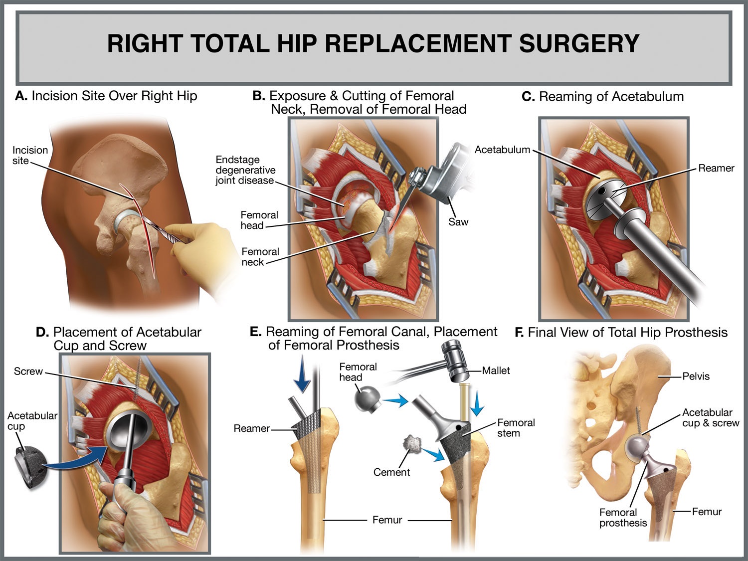 TOTAL KNEE REPLACEMENT (TKR) POST-OPERATIVE REHABILITATION