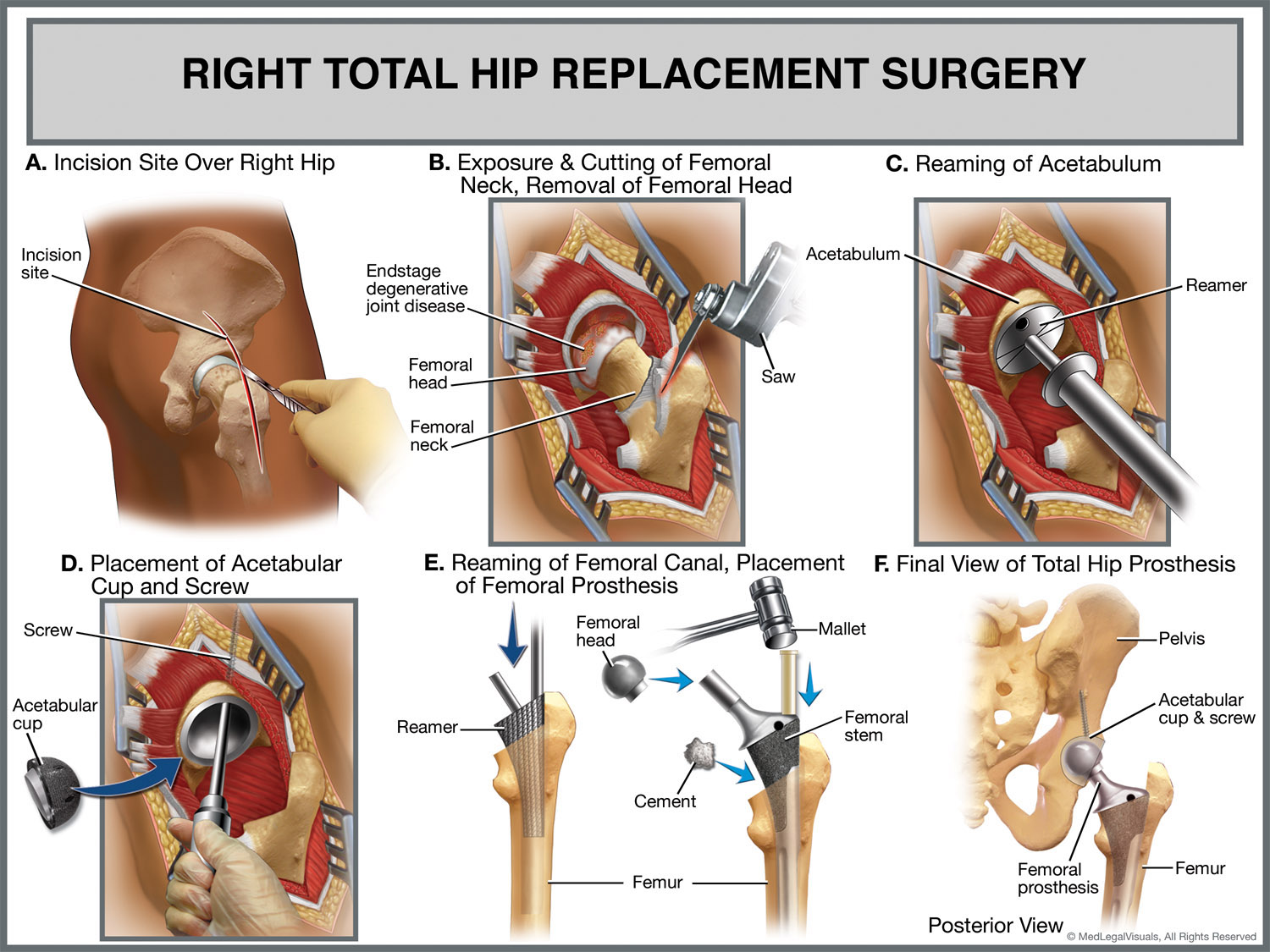 Total Knee Replacement Protocol ProOrtho